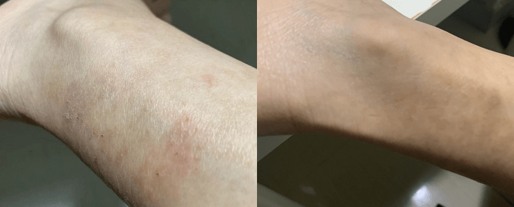 left ankle left ankle