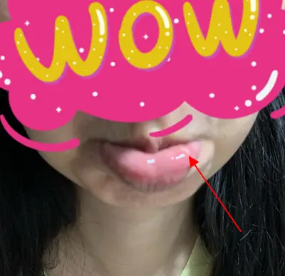 mouth ulcers mouth ulcers